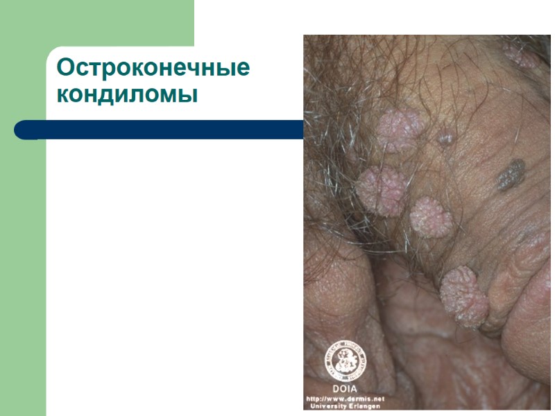 Остроконечные кондиломы